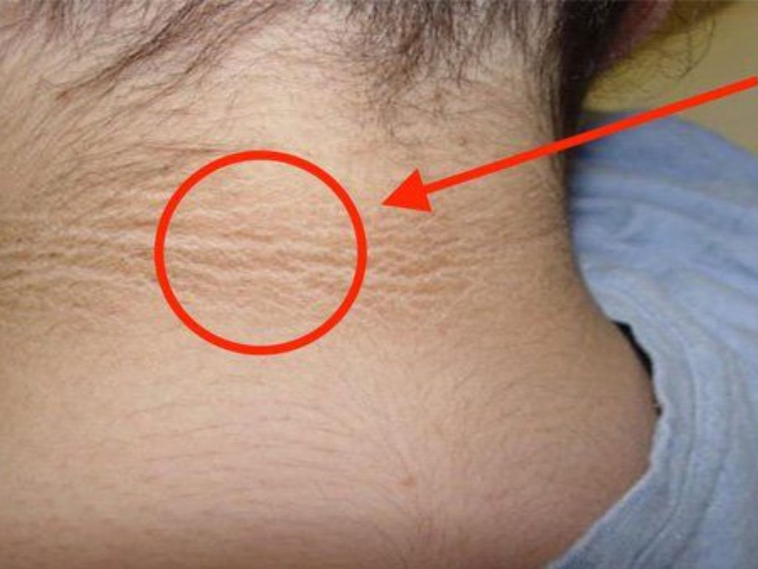 Vùng da cổ sẫm màu và dày lên có thể là dấu hiệu gợi ý tình trạng kháng insulin, thường gặp hơn ở trẻ thừa cân hoặc béo phì và nên được bác sĩ đánh giá khi xuất hiện kéo dài.