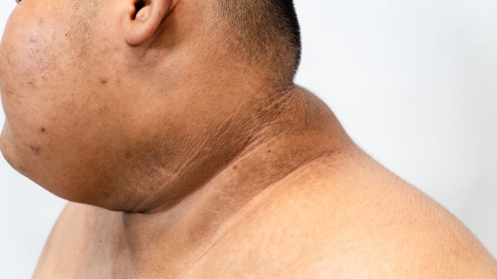 Gai đen ở cổ trẻ em: Dấu hiệu cảnh báo cha mẹ không nên bỏ qua