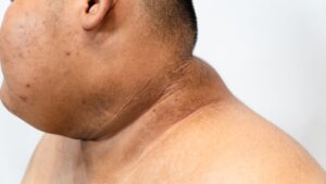 Gai đen ở cổ trẻ em: Dấu hiệu cảnh báo cha mẹ không nên bỏ qua